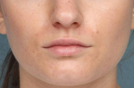 Juvederm Vollure Case 93 Before